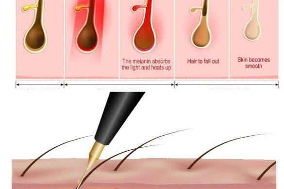 電気脱毛、レーザー脱毛、ワックス脱毛
