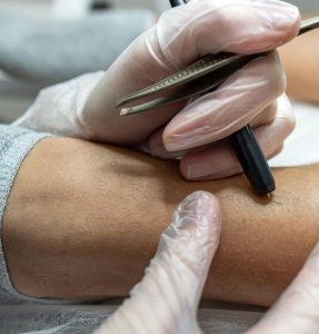 ニードル脱毛 大阪