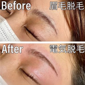 電気脱毛眉毛.jpg