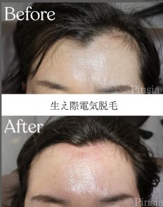 ニードル脱毛ビフォーアフター