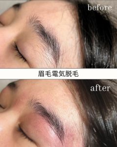 眉毛脱毛大阪